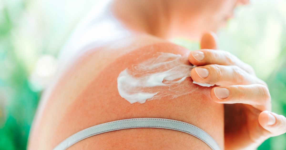 The best ways to avoid (and treat) heat rash and sun poisoning, according to derms