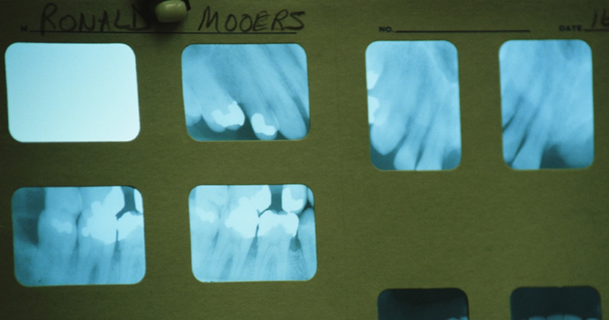 Dental Xrays can double brain tumor risk, study finds