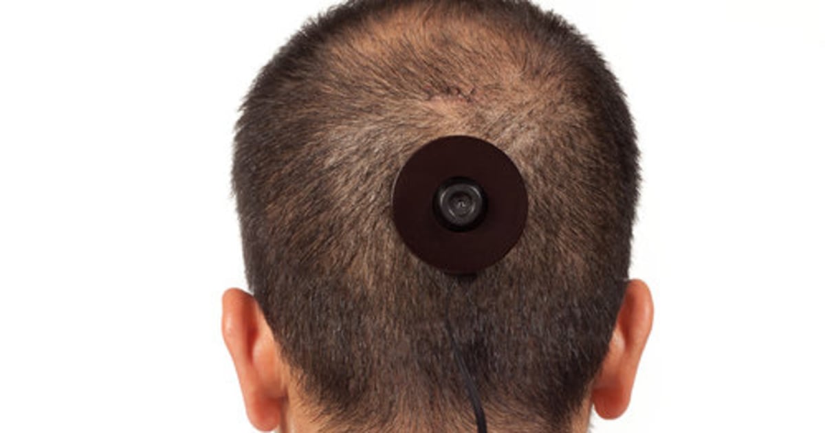 Installing a camera in a man's head proves to be painful