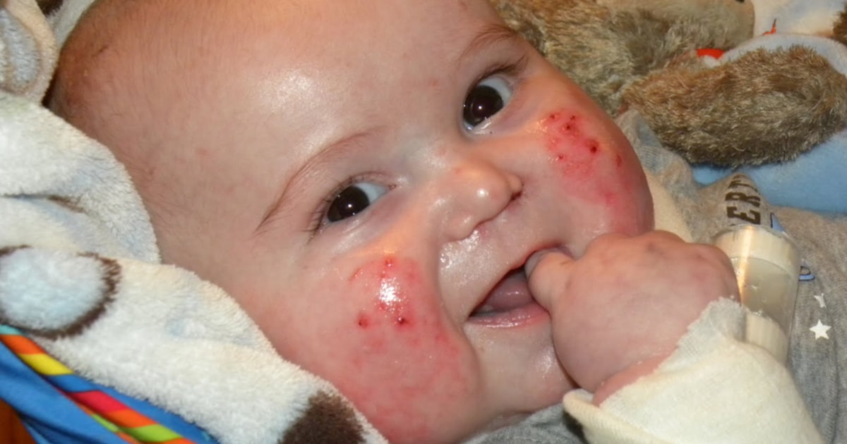 Toddler with blistering skin disease dies in his mother's arms