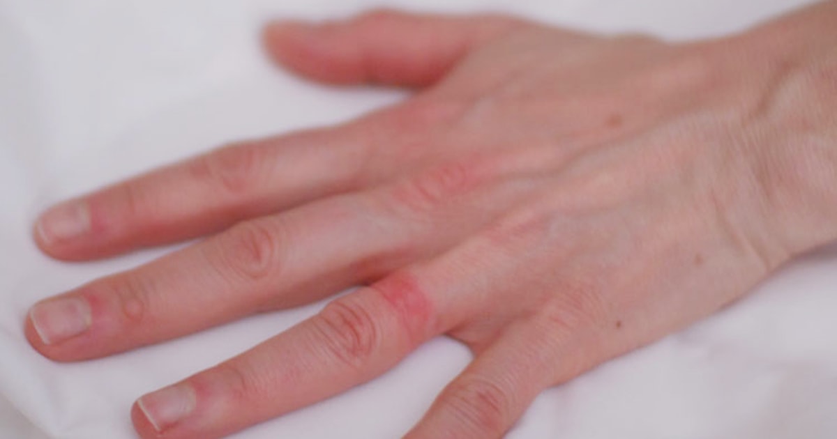 Finger swelling: Causes and their treatments