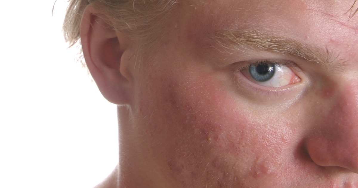 Pillowcase Acne Reddit atelieryuwa.ciao.jp