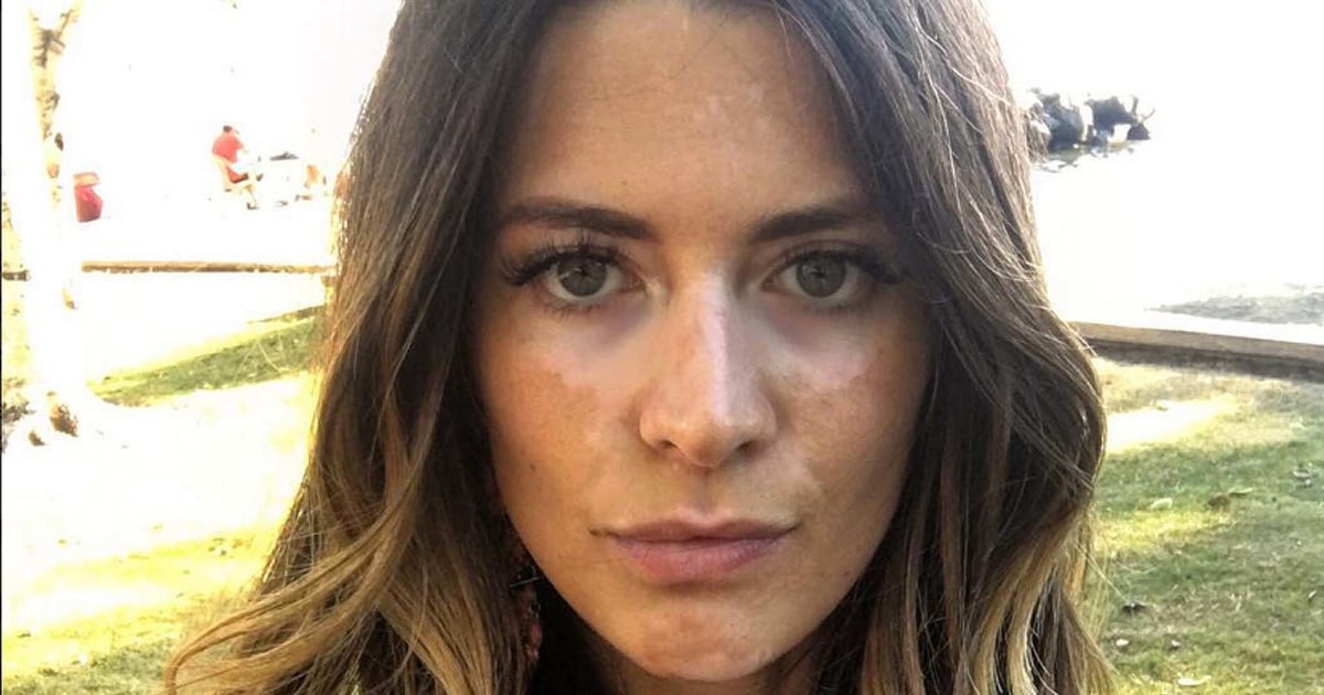 La modelo Breanne Rice tomó la valiente decisión de mostrar su vitíligo ...