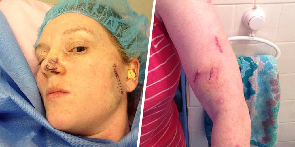 Skin Cancer Woman Diagnosed With Her First Melanoma At 23