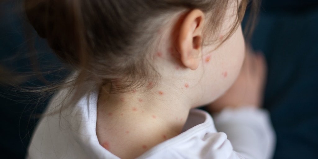 Early Measles Rash Back