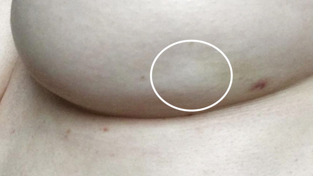 Breast cancer symptoms: What a breast dimple looks like