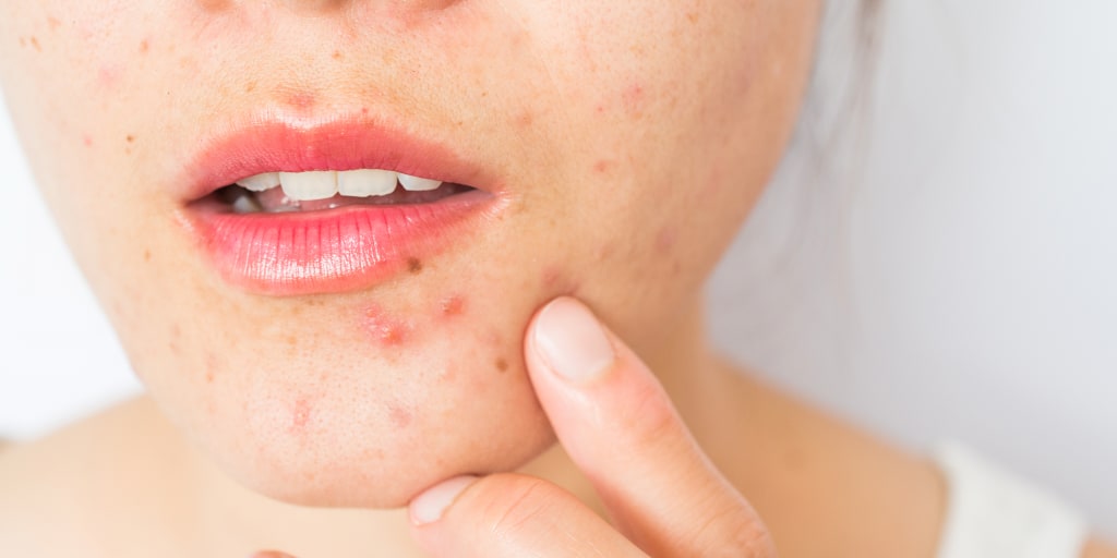 Best cystic acne clearance treatment