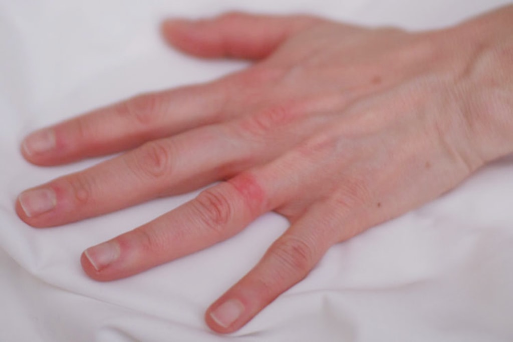 What Is Wedding Ring Rash and How Is It Treated?