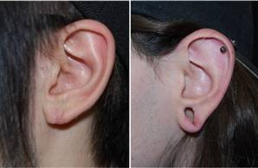 Looking for a safe and easy way to correct your ear lobe? Look no