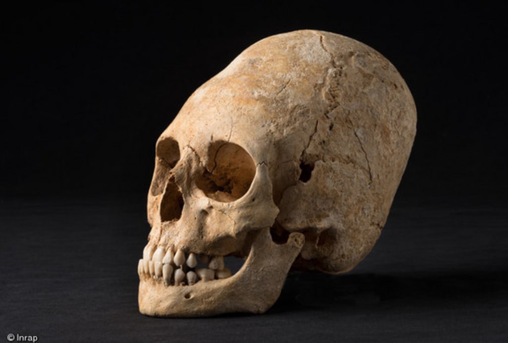 Deformed Conehead Skull From Dark Ages Unearthed In France The coneheads did not open to overly positive ratings, and it's not surprising it didn't. deformed conehead skull from dark
