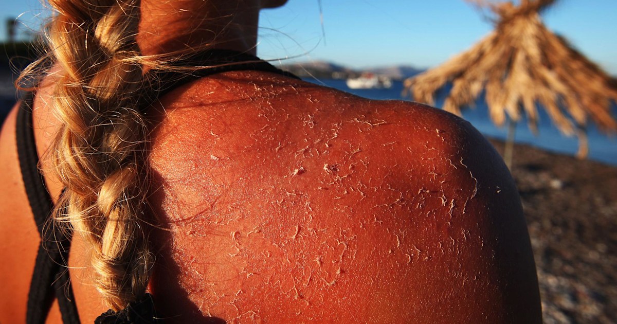 How Many Sunburns Does It Take To Get Skin Cancer