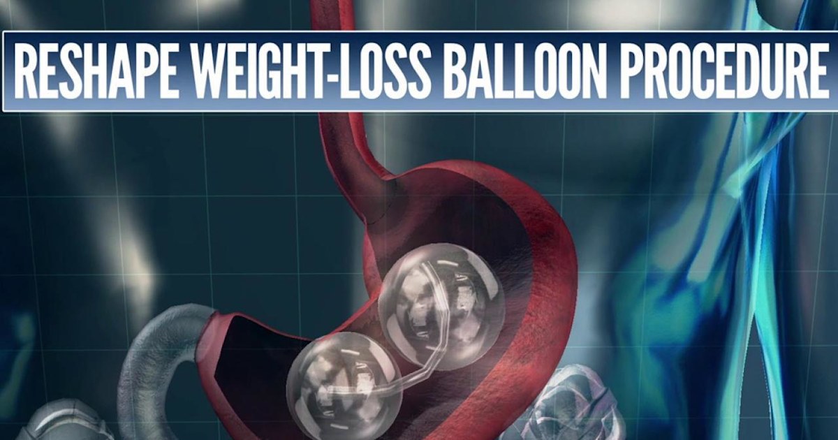 FDA investigates deaths connected to certain weightloss balloons