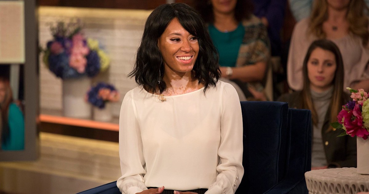 Vitiligo didn’t stop this young woman from becoming a CoverGirl model
