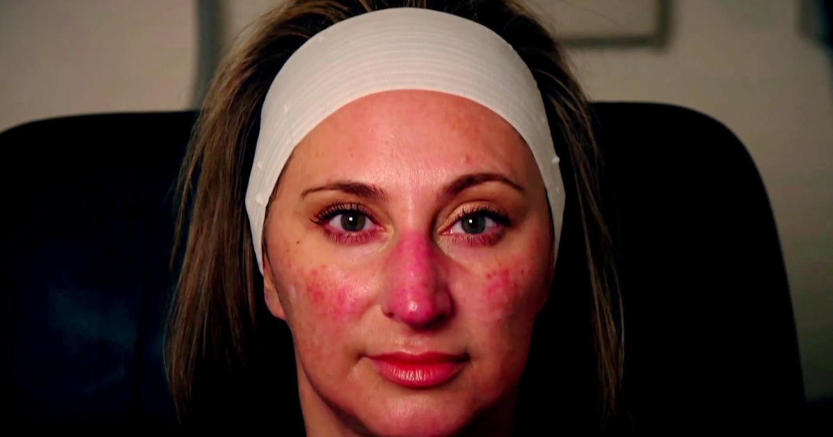 What is 'Ozempic face'? Unexpected side effect sparks complaints