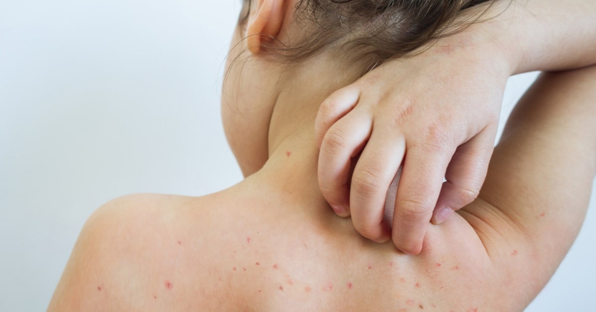 Measles Outbreak Spreads in South Carolina With 400+ Cases