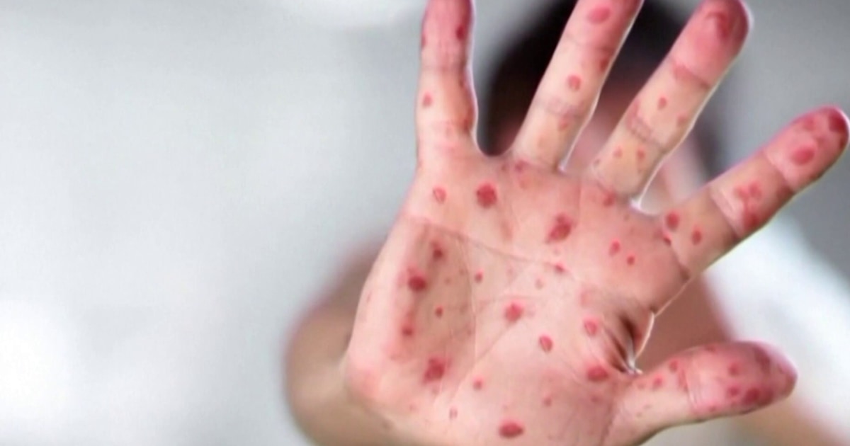 Measles Outbreak in South Carolina Doubles in a Week