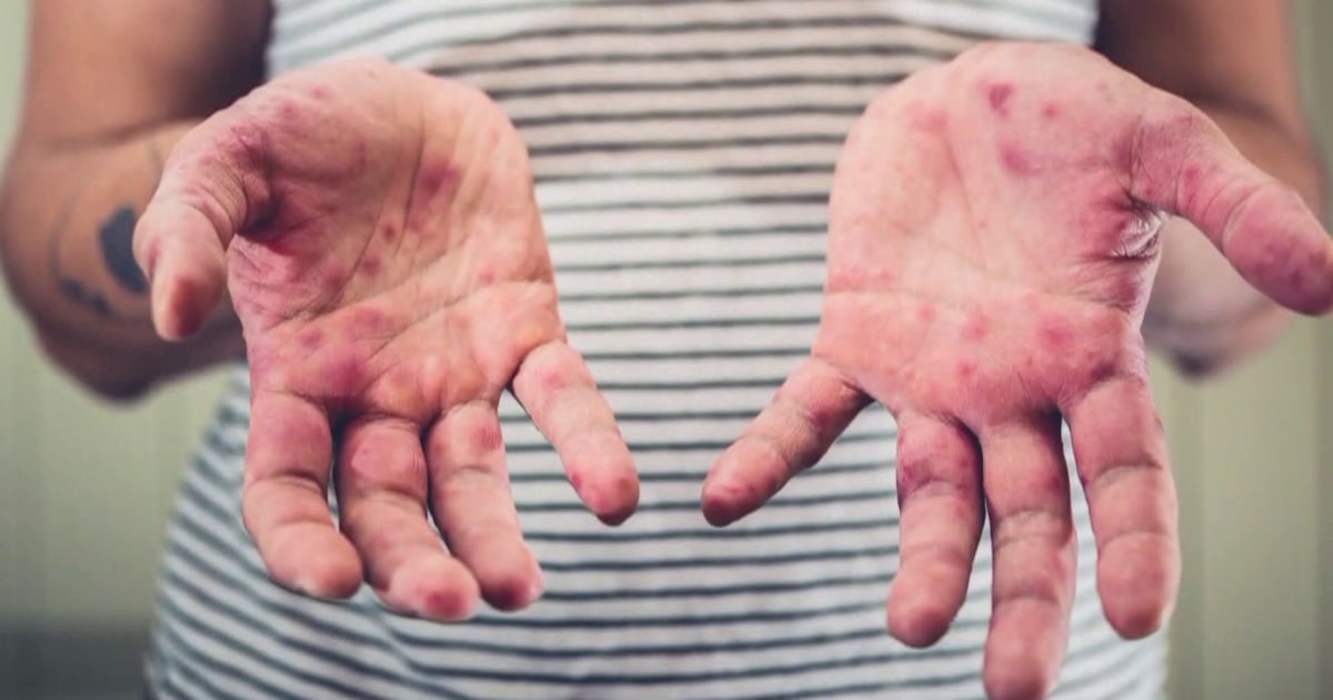 South Carolina Measles Cases Double in Just 1 Week