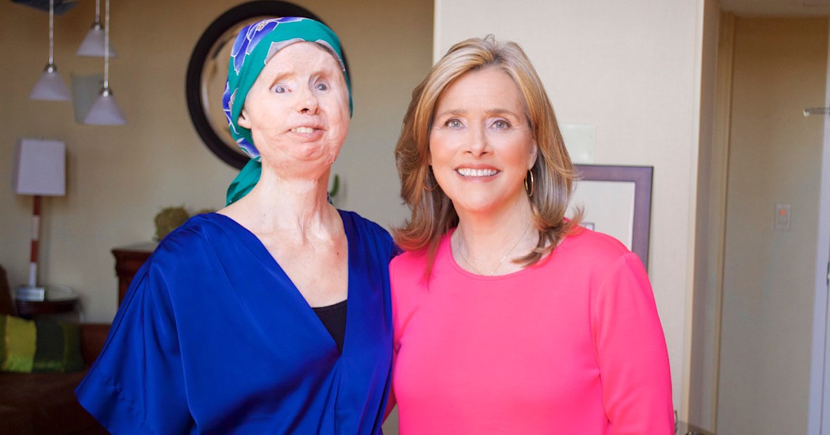 Charla Nash opens up about recent face transplant setback, living independently