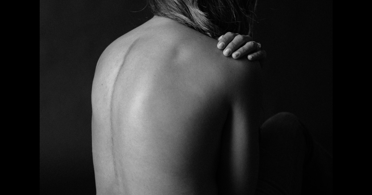 Why I Love My Scoliosis Scar From Wearing A Back Brace Discover brandi milloy's biography, age, height, physical stats, dating/affairs, family and career updates. my scoliosis scar from wearing a back brace