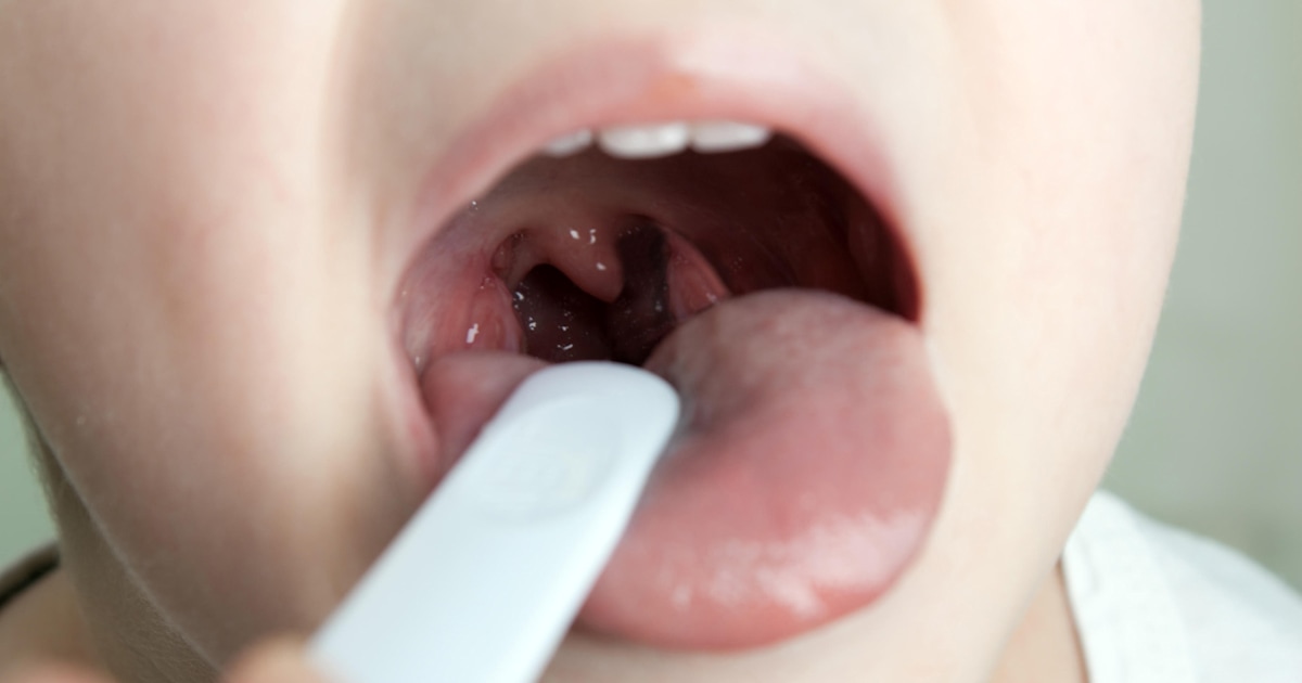 Does a tonsillectomy reduce sore throats? 2 studies weigh in