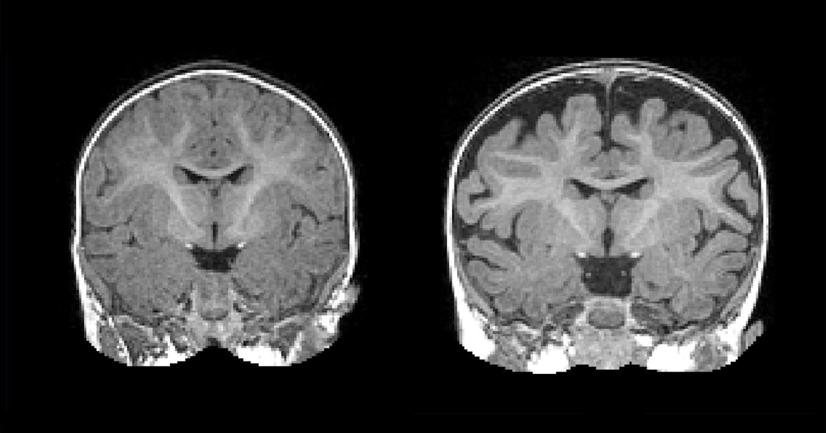 Excess brain fluid may predict autism in high-risk babies