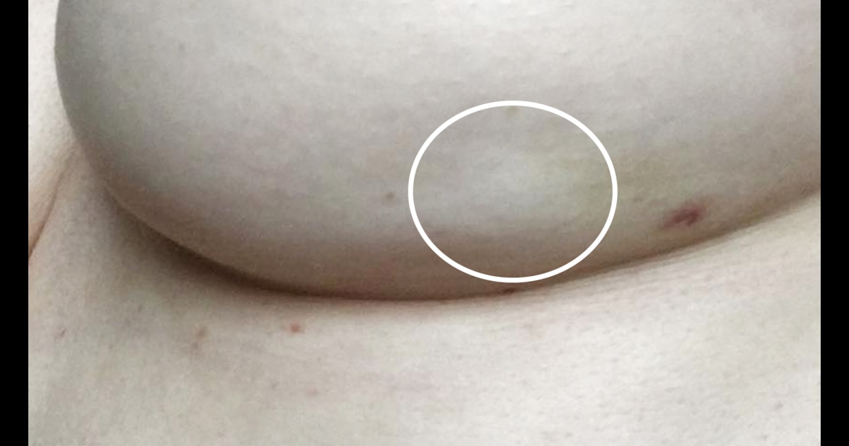 Breast Cancer Symptoms What A Breast Dimple Looks Like