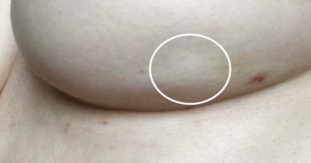 Breast cancer symptoms What a breast dimple looks like