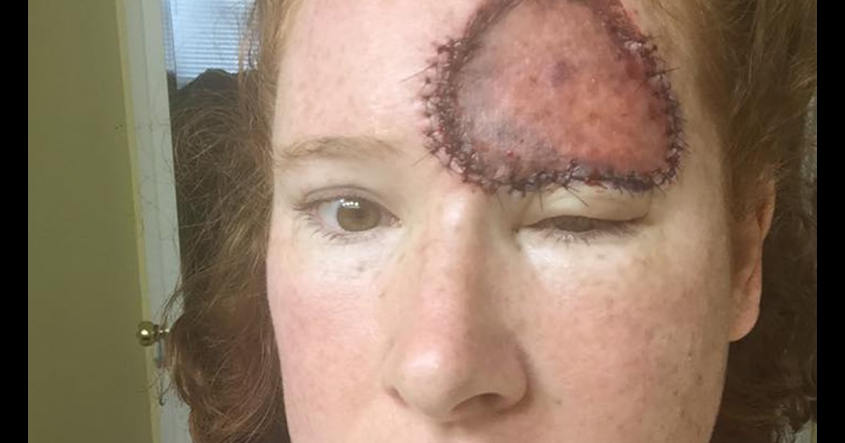 Symptoms of skin cancer: Woman's melanoma looked like liver spot