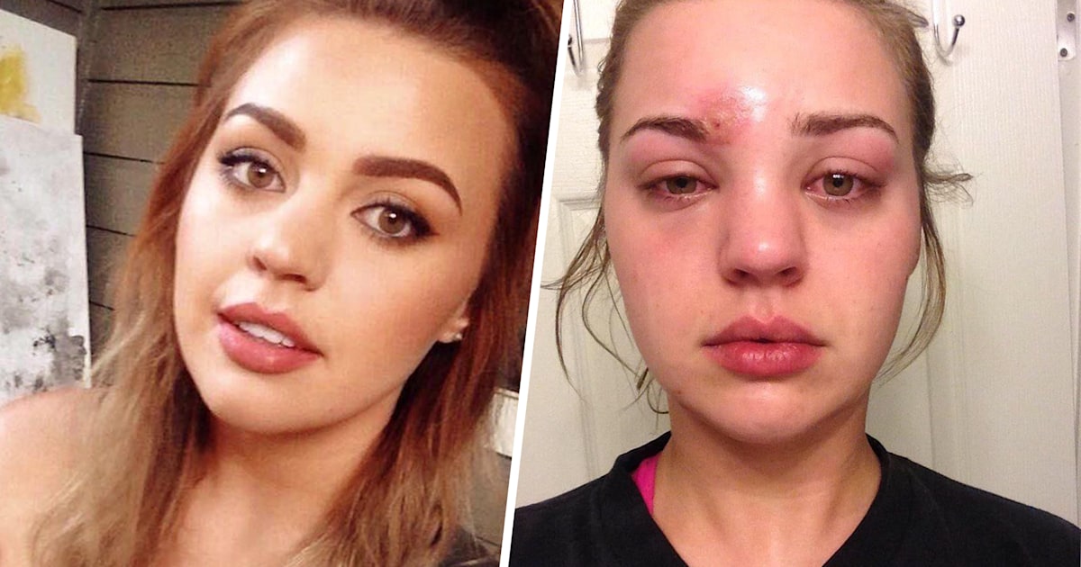 Staph Infection On Lips Swollen Lipstutorial
