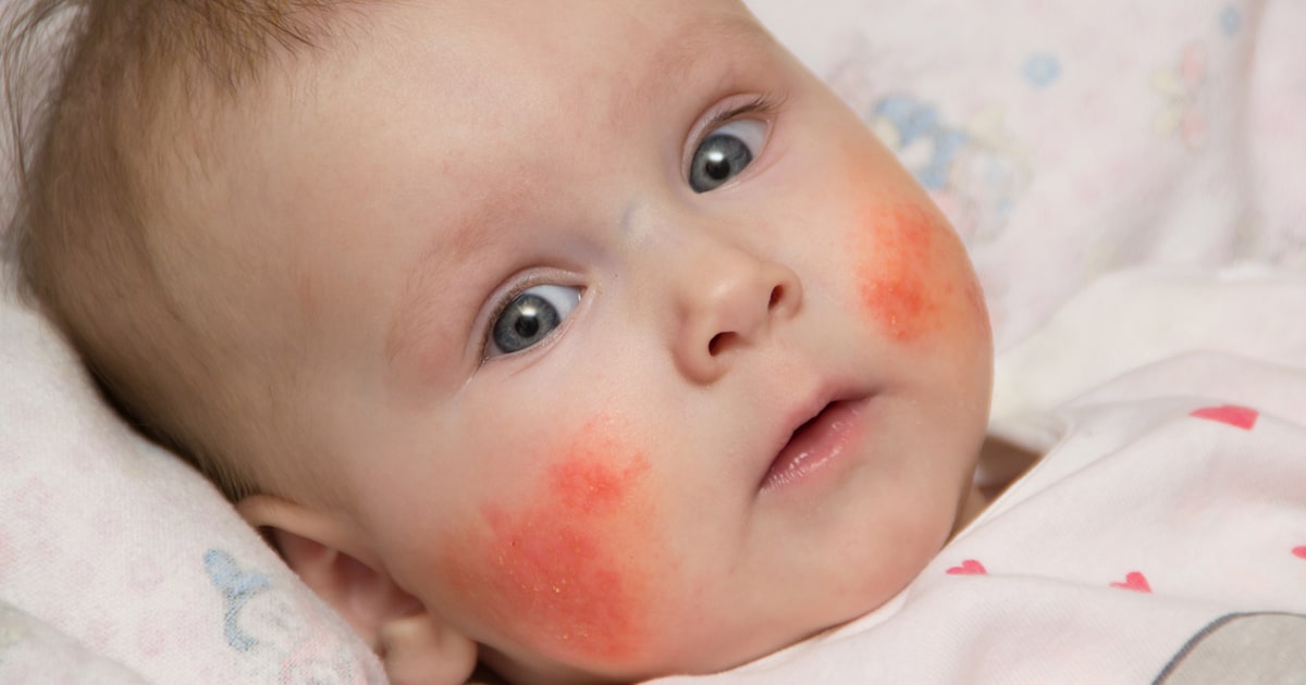 How to know if your child might be at risk for food allergy