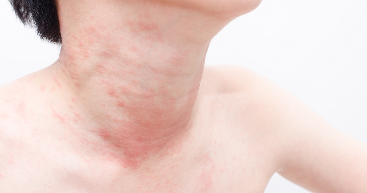 Unusual Flu Symptoms Are Hives A Symptom Of The Flu