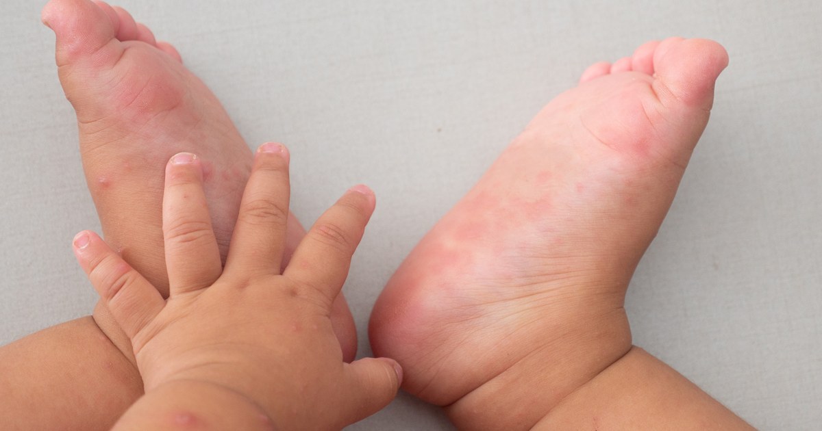 Hand Foot And Mouth Disease Symptoms Causes And Treatments