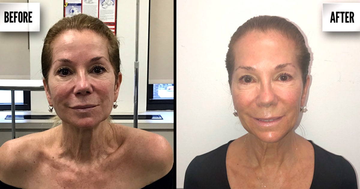 What is Ultherapy? Cost and review of the mini lift without surgery