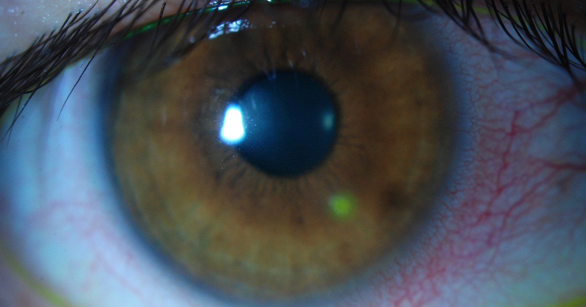 Contact lens infections Horror stories and advice on what not to do
