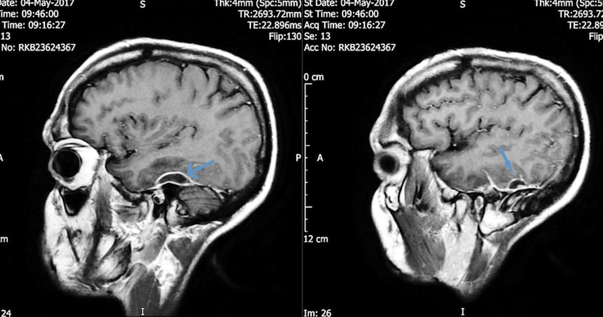 Cotton swab stuck in ear led man to suffer seizures, skull infection