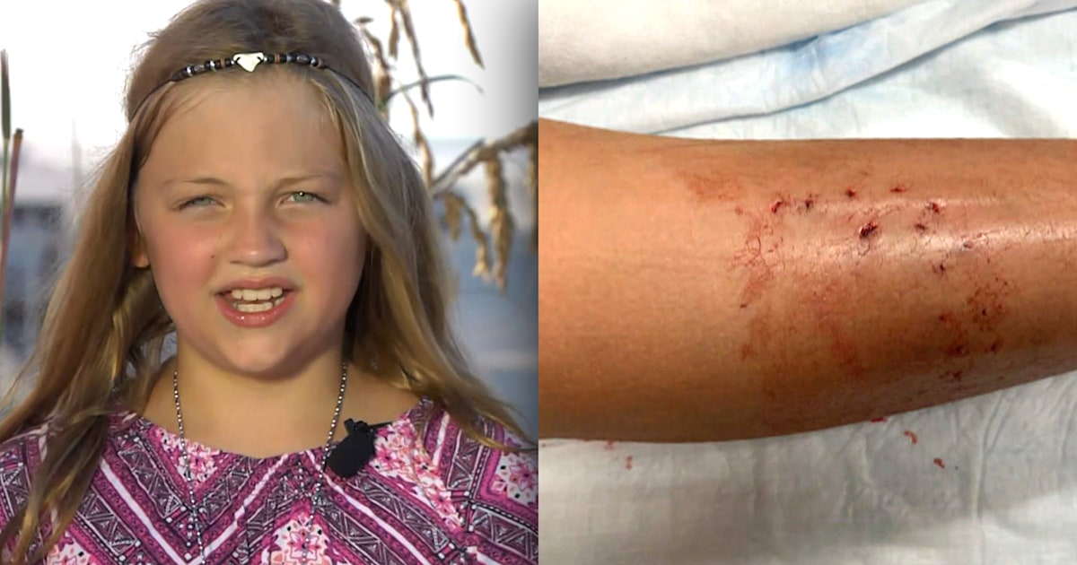 9 Year Old Girl Details Shark Attacked Off New Smyrna Beach 