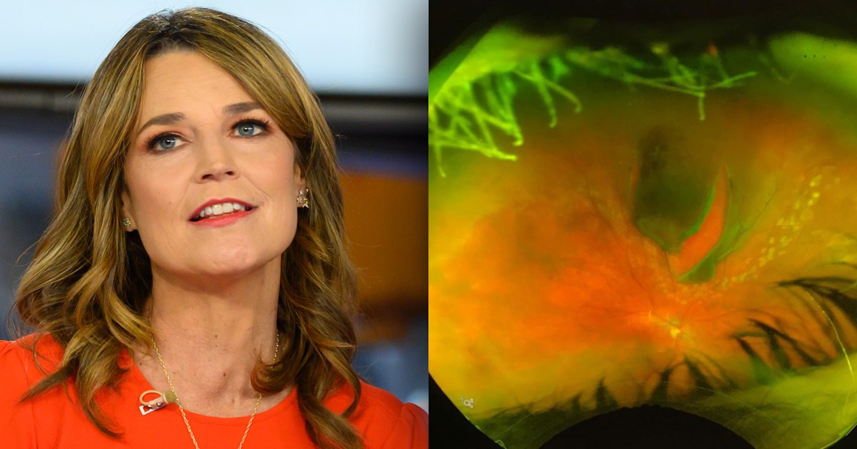 Savannah Guthrie shares before and after photos of torn retina