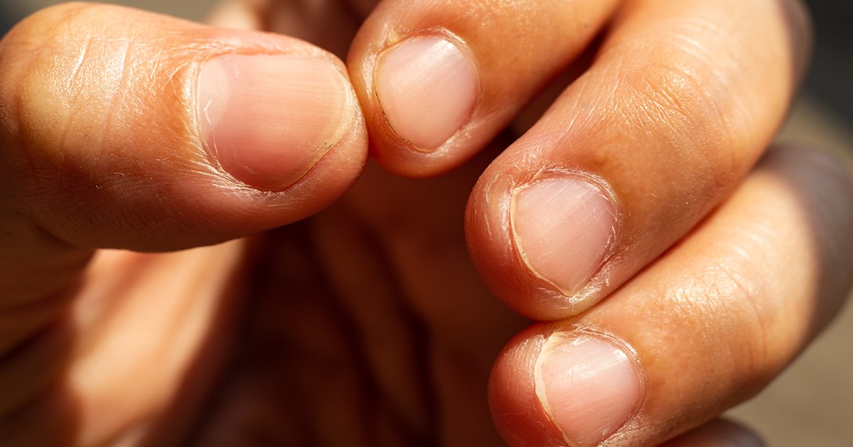 Try this therapy if you want to get rid of nail biting habit-totobed.com.vn