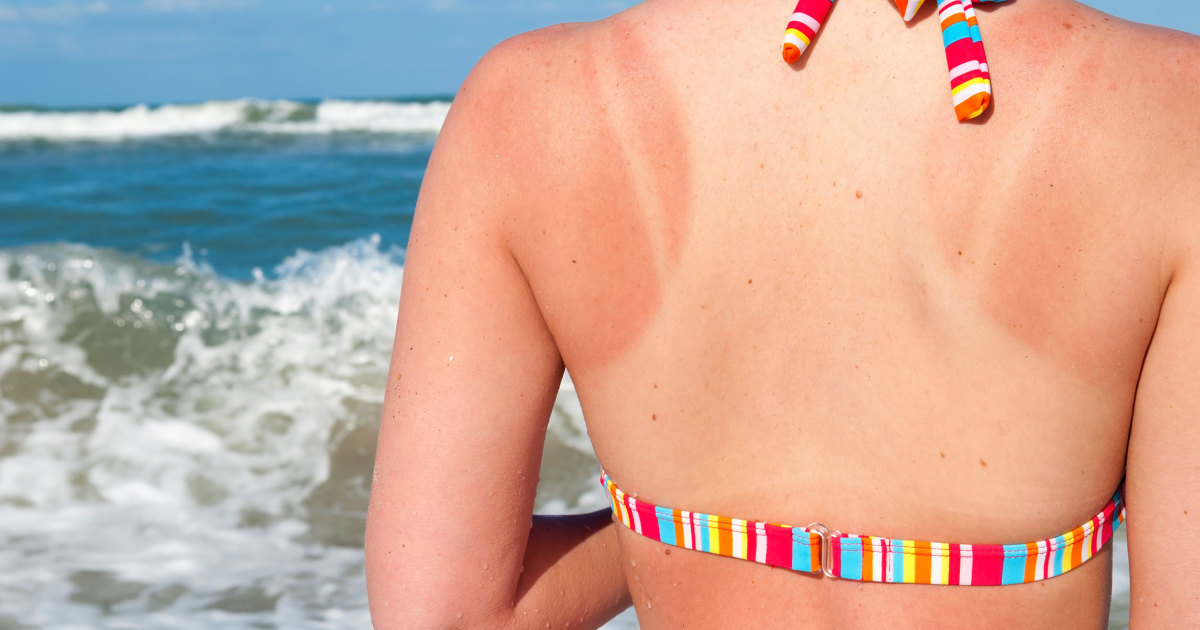 Earthley - Too much fun in the sun can leave you with red, swollen,  sensitive skin - AKA a sunburn. Sunburns can be pretty painful, but will  usually start to feel better