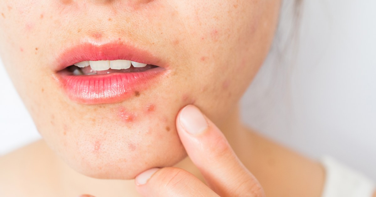 What is cystic acne? Dermatologists explain how it differs from regular acne