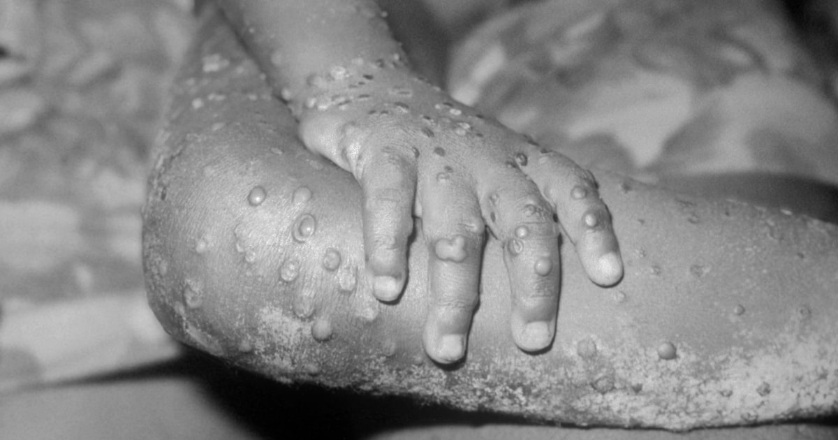 Symptoms and causes of monkeypox infection, which the CDC calls a “new problem”