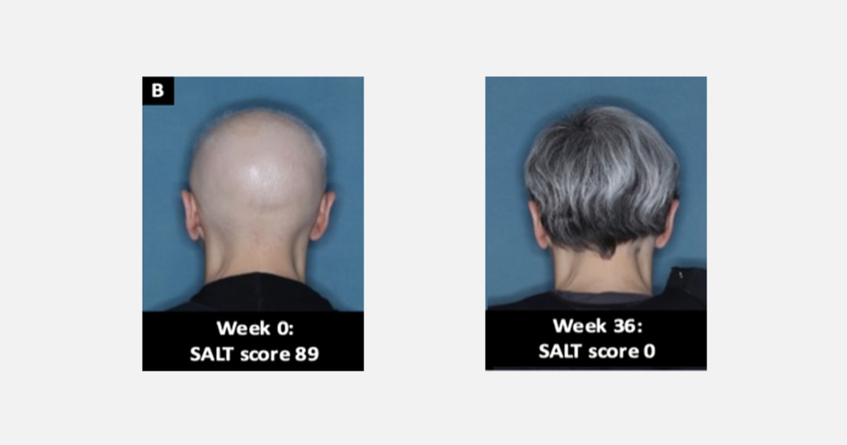FDA approves 1st treatment for alopecia hair loss
