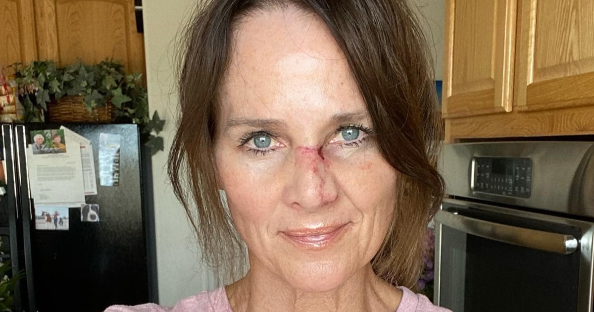 TV meteorologist shares startling photos of skin cancer ordeal: 'You can survive this'