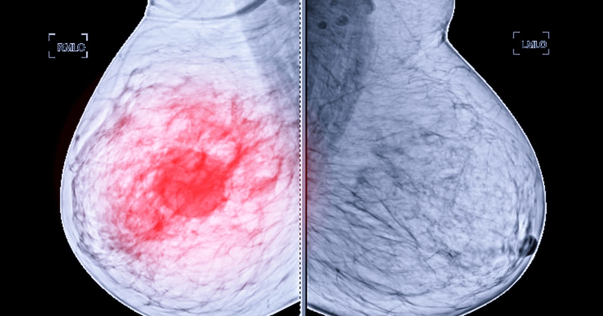 Breast cancer - The Argyle Surgery