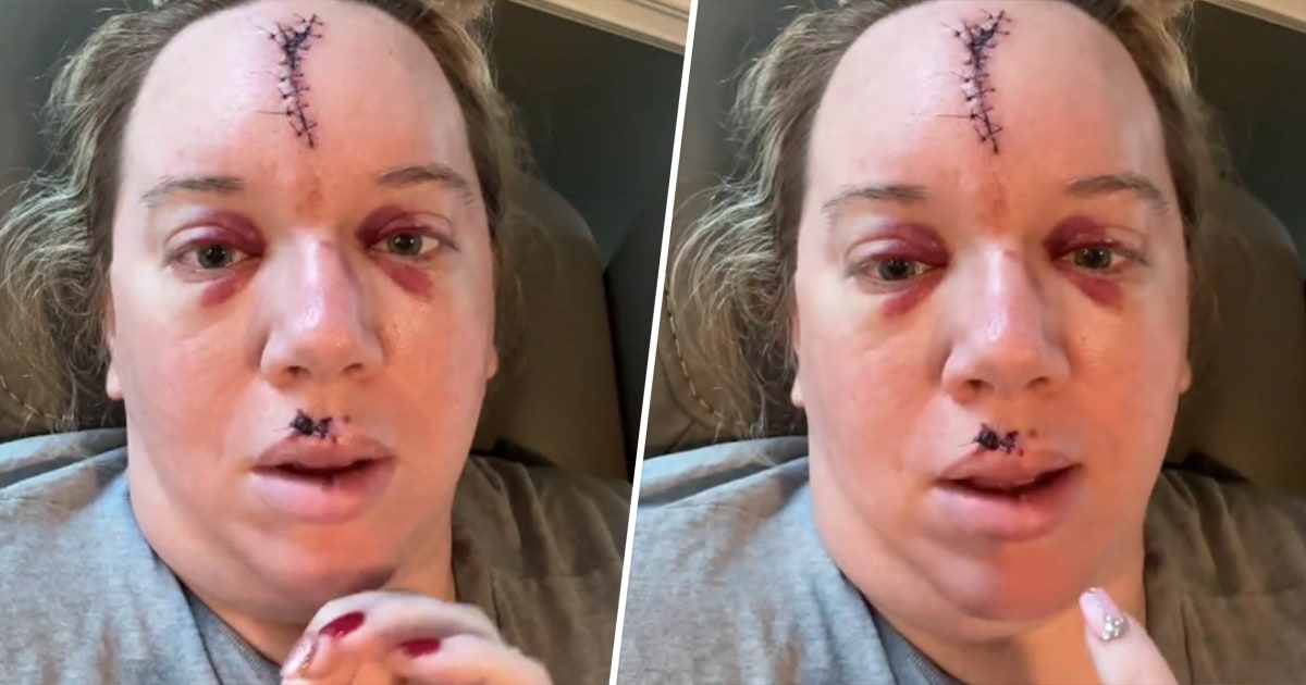 Woman Warns About Passing Out After Fainting Causes Face Scar