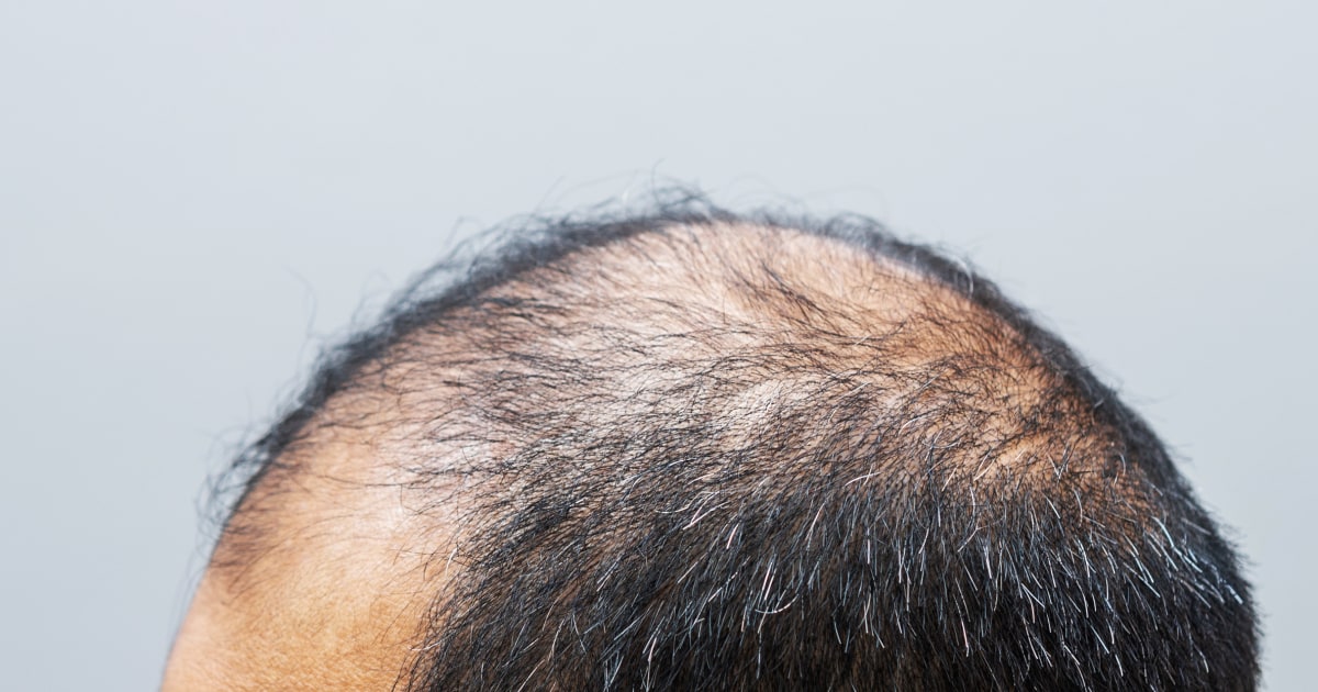 Minoxidil, drug that treats thinning hair, may be in short supply