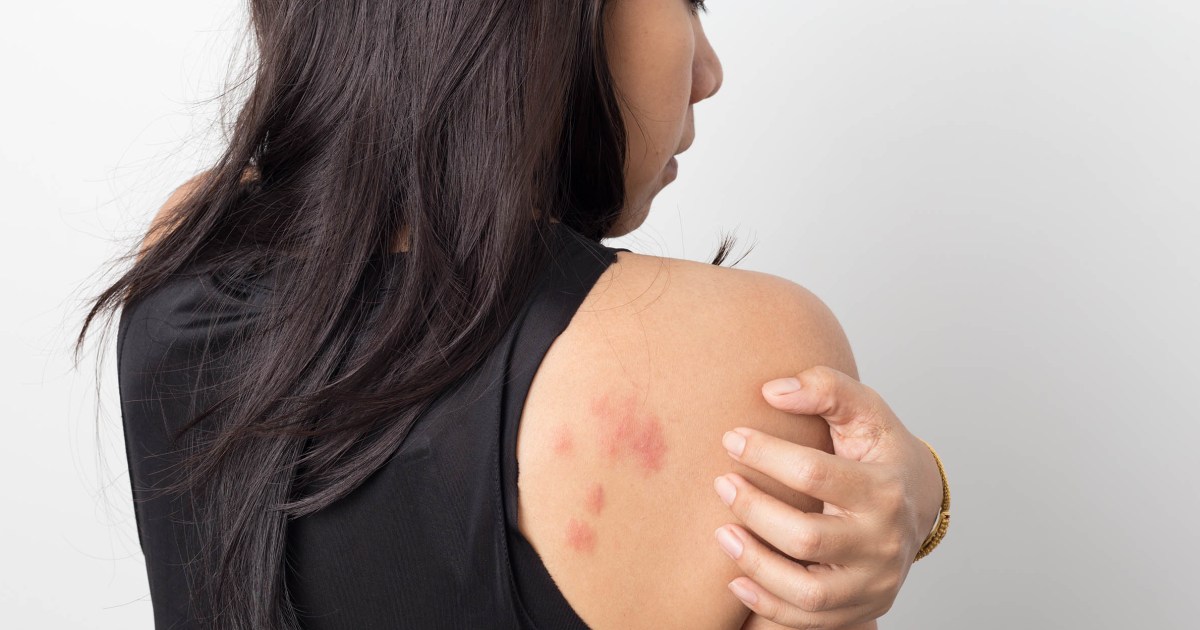 These 23 skin rash pictures can help you decipher your skin