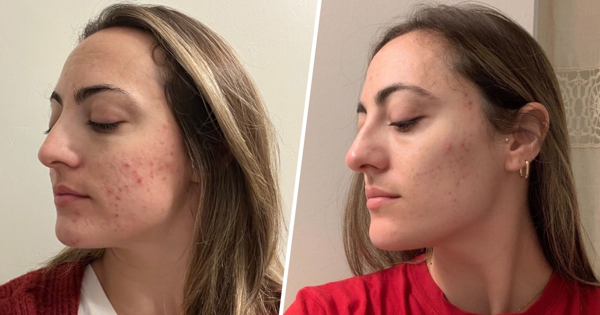 These brightening and exfoliating pads got rid of dark spots I've had for years