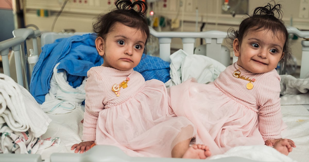 15-Month Old Conjoined Twins Successfully Separated After 18-Hour Surgery