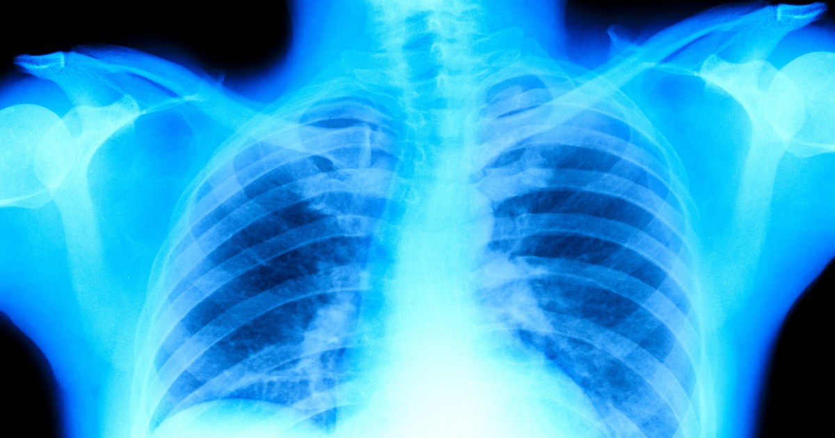 7 Lung Cancer Symptoms A Doctor Monitors In Himself